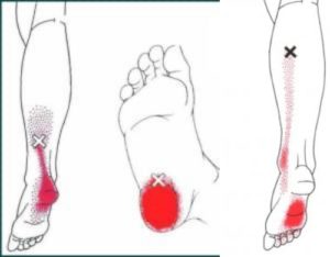 足底筋膜炎のトリガーポイント