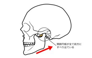 顎関節症のイラスト関節円盤が後方に下がった図